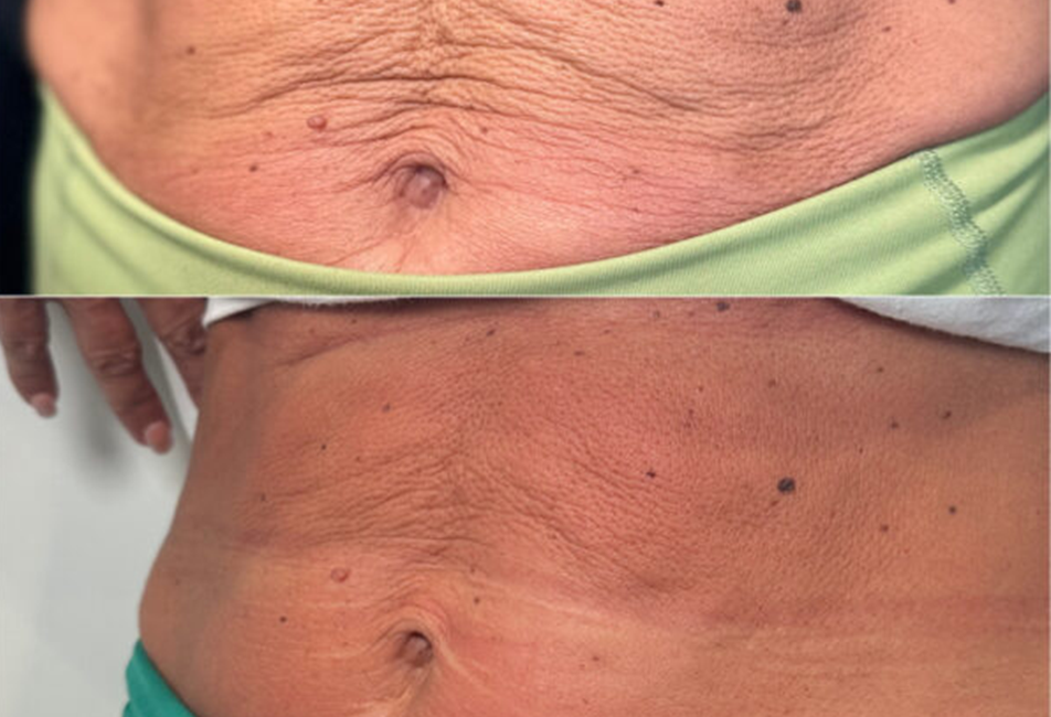 BioStimulator, Scultra stomach injections, improving skin laxity.