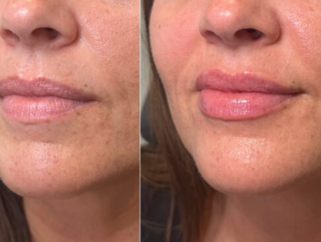 Lip Filler Before and After, Aesthetic Services