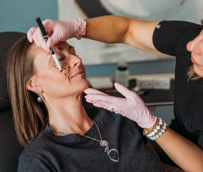 Facial mapping marked out before a dermal filler treatment at Yoo Direct Health